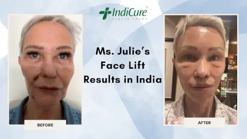 Ms. Julie's Facelift Results in India